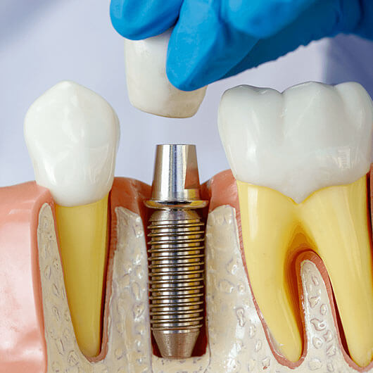 Dental Implants