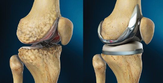 Joint Replacement Treatment | Joint Replacement Surgeon in Nashik