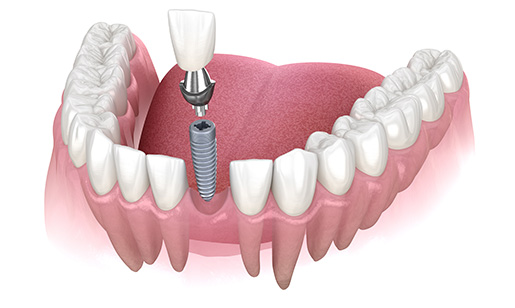 diş implantı