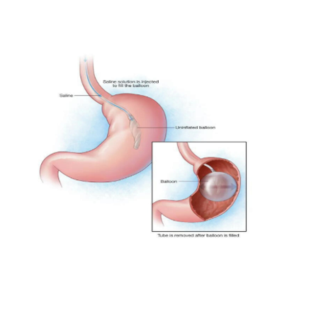 Intragastric Balloon Insertion