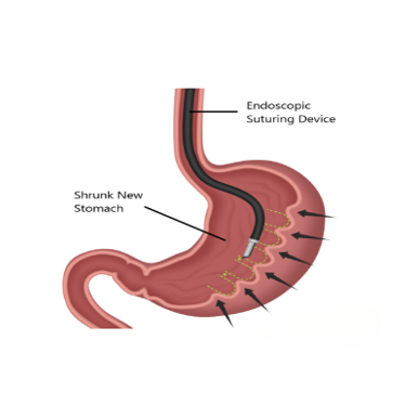 Endoscopic Sleeve Gastroplasty