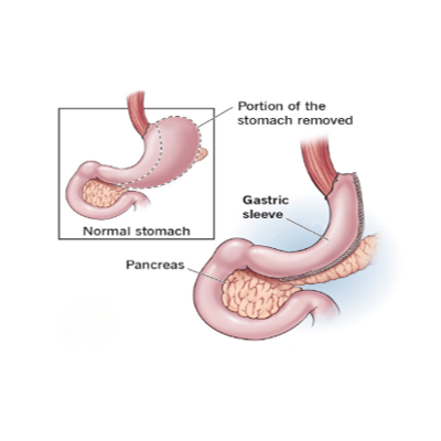 Sleeve Gastrectomy