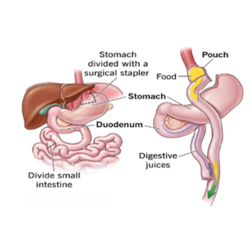 Roux-en-y-Gastric Bypass