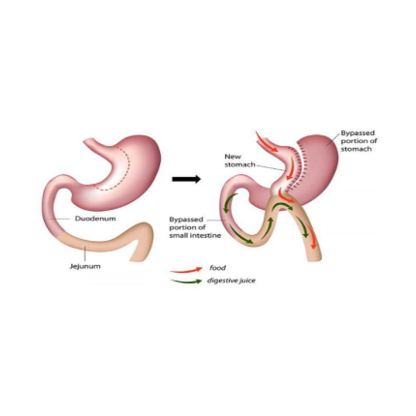 Mini Gastric Bypass