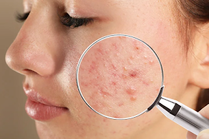 Acne Treatment in Lucknow Indira Nagar