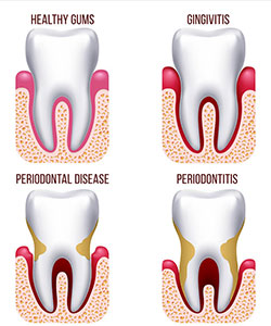 Gum Disease Prevention