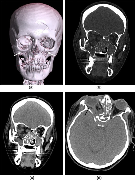 Maxillofacial Trauma