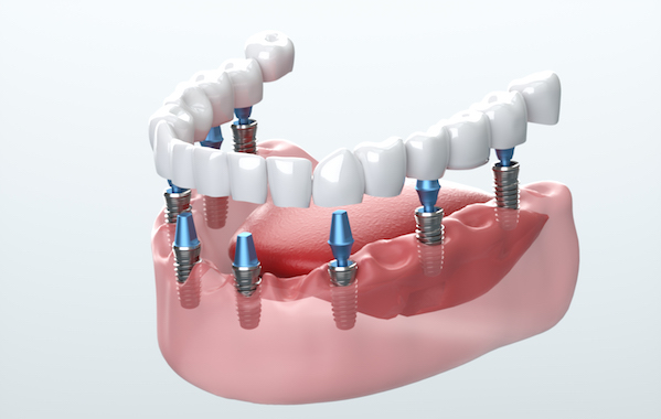 Implant utilisé en odontostomatologie