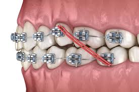 Implant utilisé en odontostomatologie