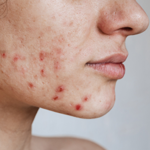 Skin Specialist in Lucknow for Acne