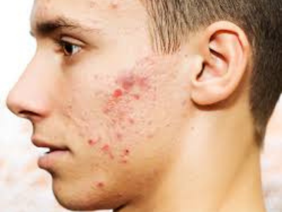 Best Skin Doctor in Lucknow for Acne