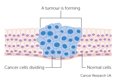 Tumor cells