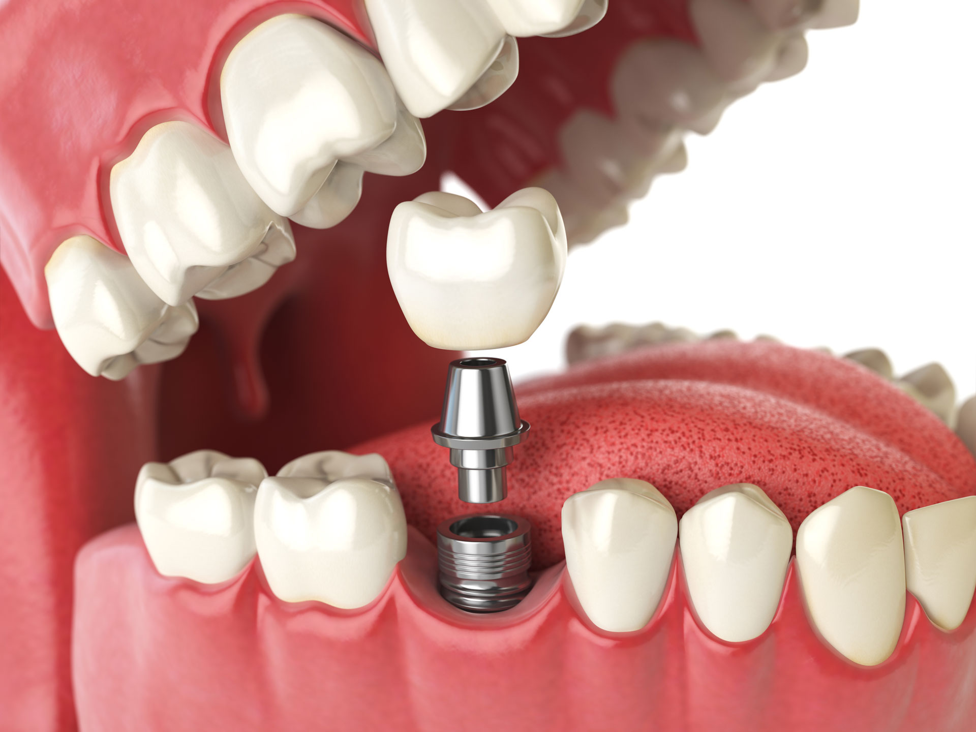 Implantate für die Zahnmedizin / Zahnimplantate