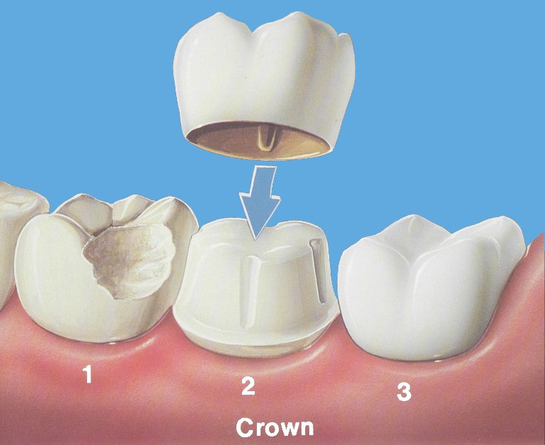 Dentalimplantat