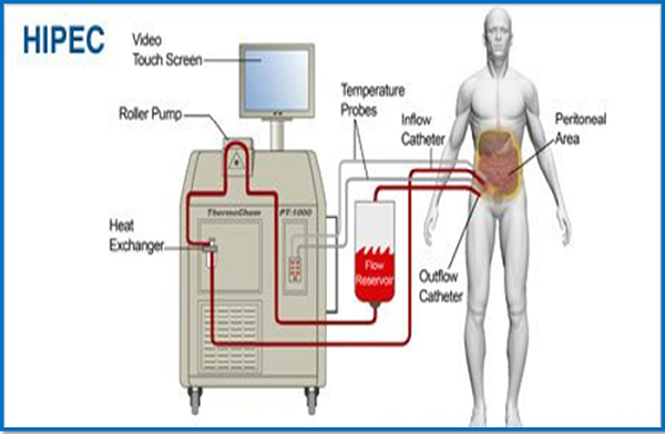 Apparatuur voor kankerbehandeling met RF-thermotherapie