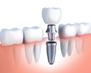 Encino Dental Implant