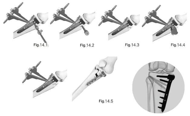 Instrumentos y aparatos quirúrgicos