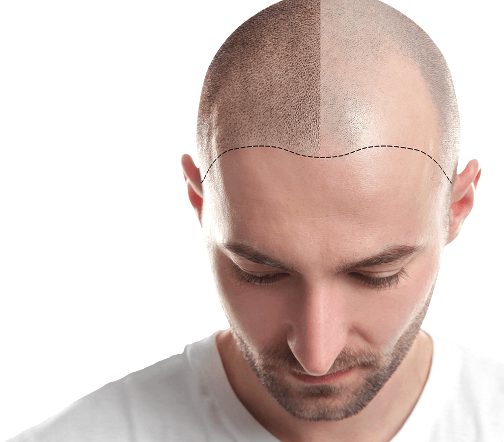 Hair Transplant in Ahmedabad