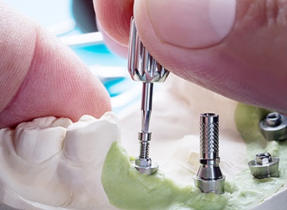 Dental Implants