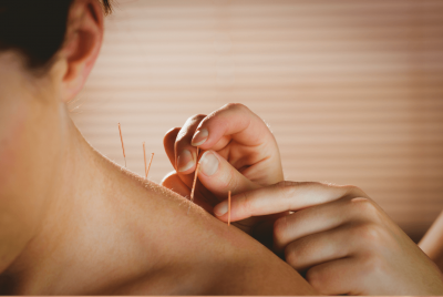 Acupuncture მკურნალობა