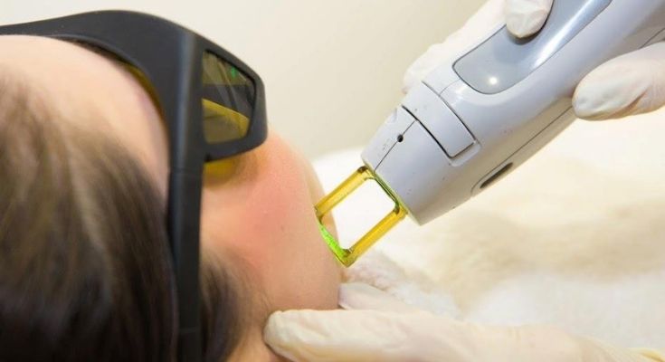 Máy tẩy lông bằng laser