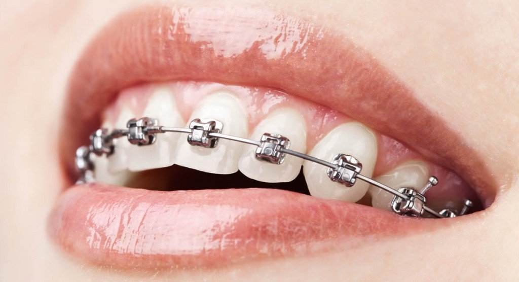 Orthodontische tandbeugels